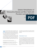 Esthetic Rehabilitation of Tetracycline-Stained and Worn Teeth With Porcelain Laminate Veneers