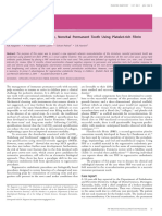 Revascularizing Immature Teeth Using PRF