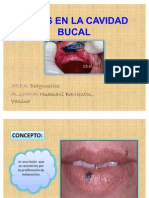 Nevus en La Cavidad Bucal