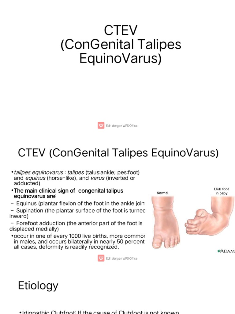 Understanding Congenital Talipes Equinovarus Classification