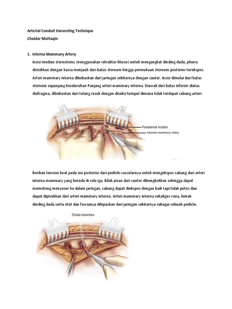 Arterial Conduit Harvesting Technique PDF