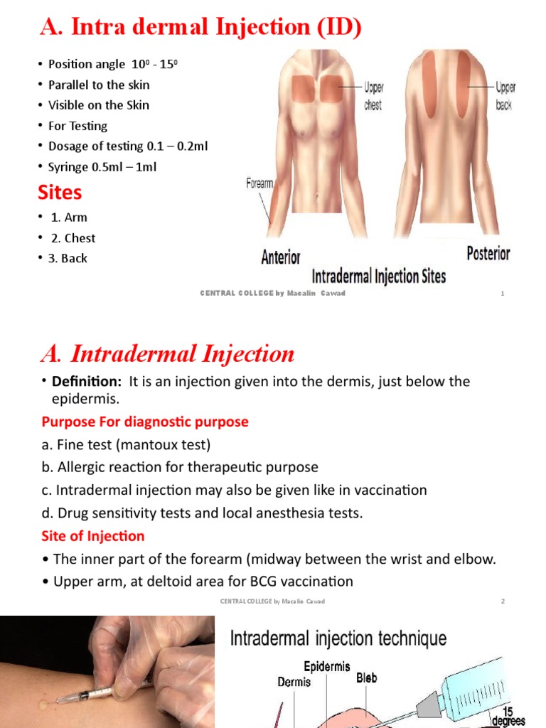 Intradermal Injection Techniques and Sites | PDF | Injection (Medicine ...