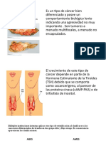 Carcinoma Papilar