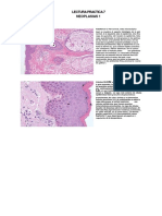 Lectura Practica 7 Neoplasias 1 (Neoplasias Epiteliales)