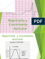 Hipertrofia Auricular