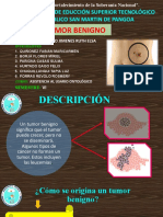 Tumor Benigno