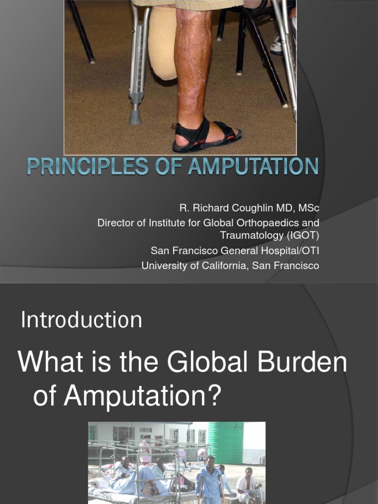 Principles of Amputation | PDF | Amputation | Prosthesis