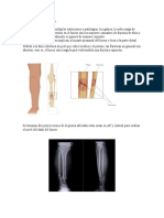 Fractura de Tibia y Peroné