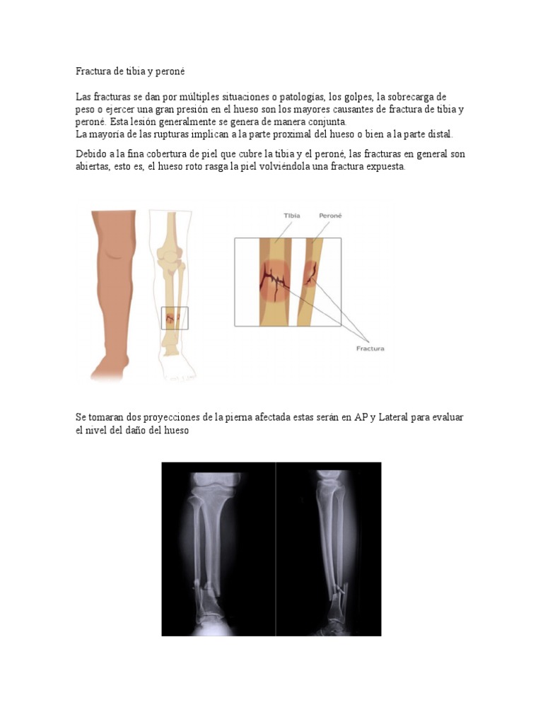 Fractura Tibia y Peroné: Causas y Tratamiento | PDF