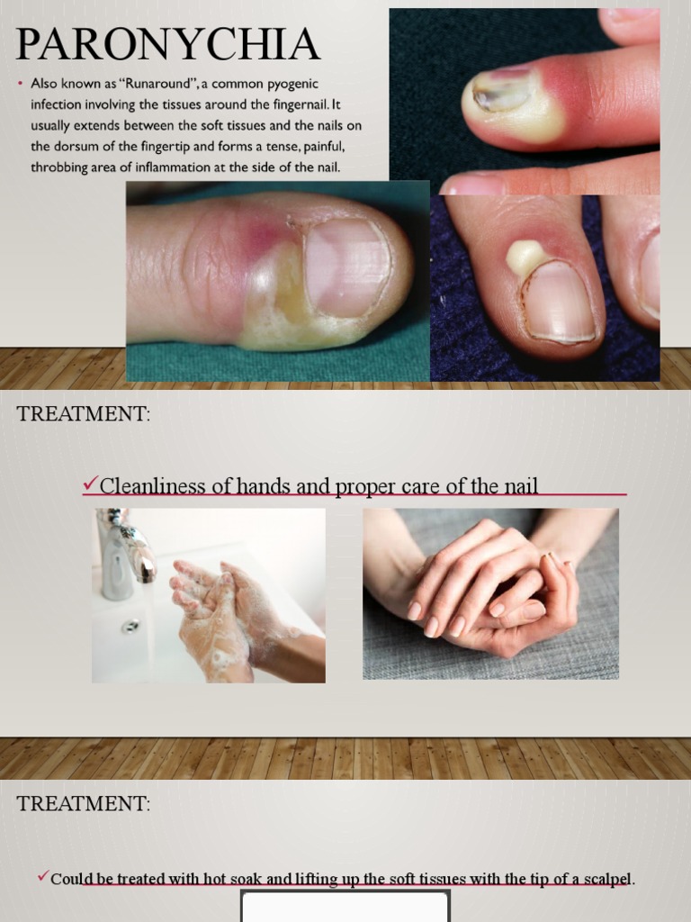 Paronychia PDF Animal Diseases Microbiology