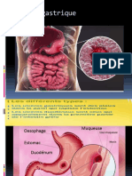 Ulcèregastrique