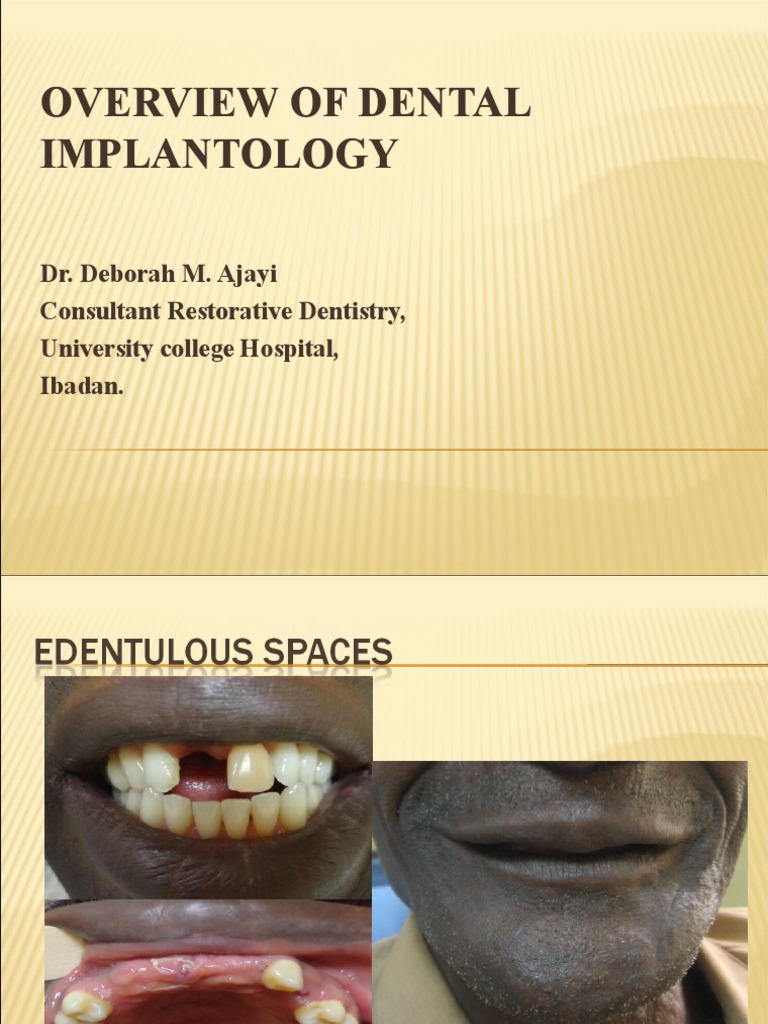Dental Implant Restoration Overview | PDF | Dental Implant | Dentistry
