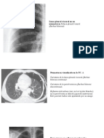 Neumotorax y lesiones pulmonares