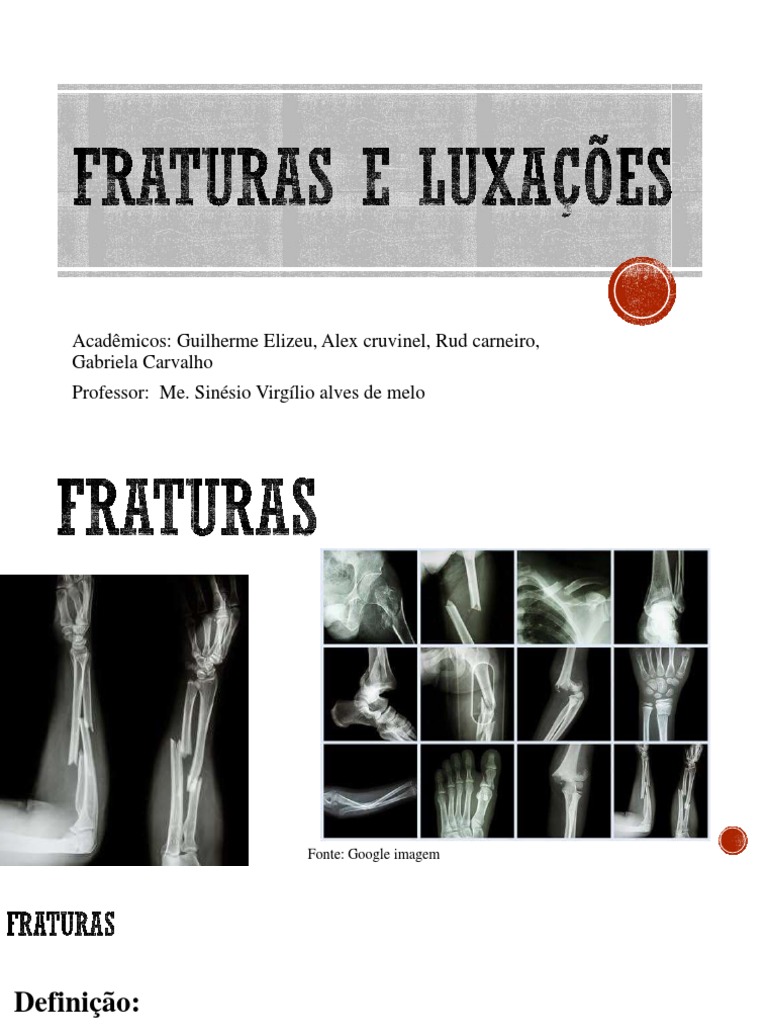 Entorses, Fraturas E Luxações: Saiba A Diferença – CBTYK