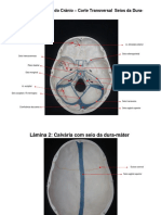 Seios da dura-máter e artérias cerebrais