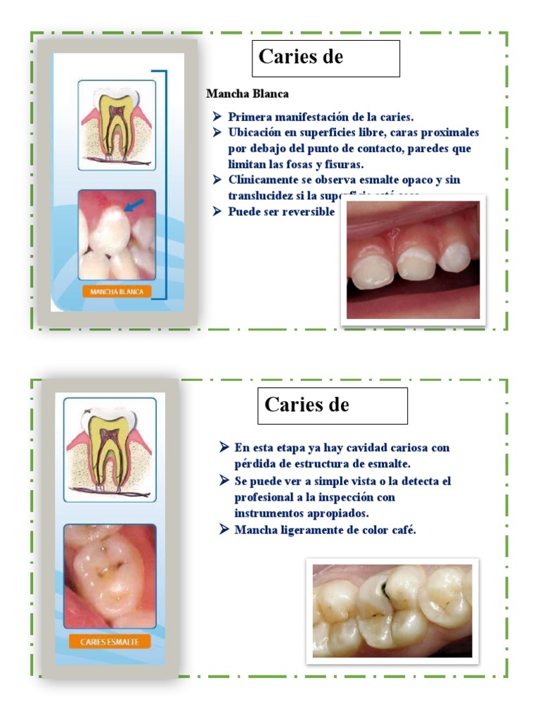 Copia de Caries | PDF | Esmalte de dientes | Causas de la muerte