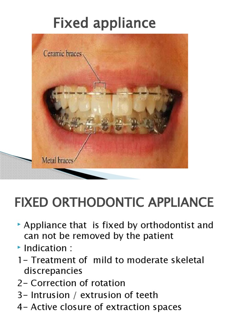 Understanding the Components and Techniques of Fixed Orthodontic