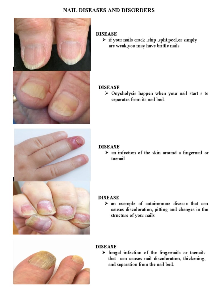 Common Nail Diseases and Disorders | PDF | Home & Garden