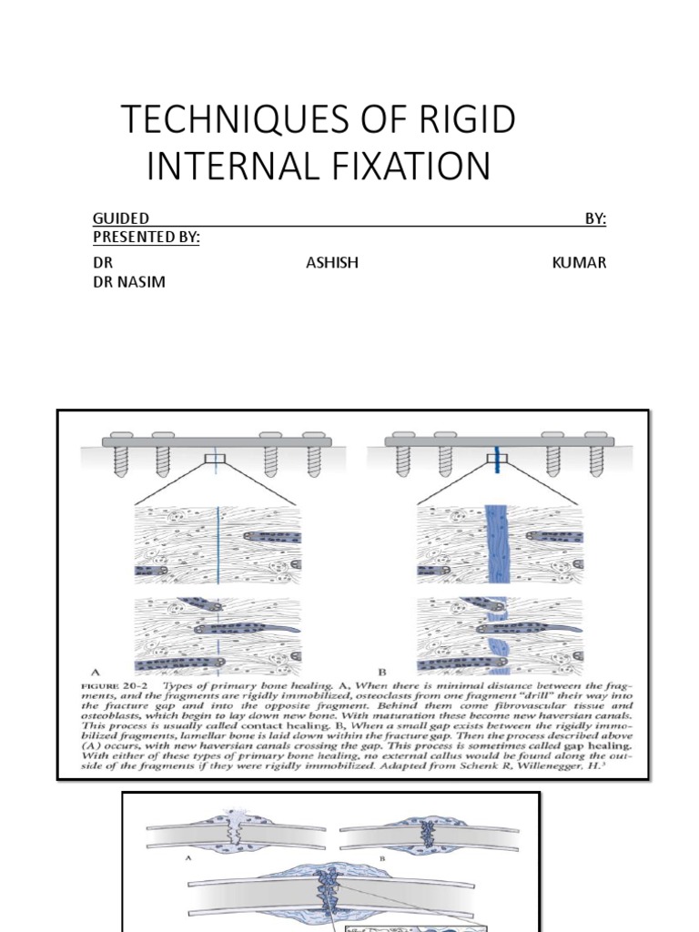 Rigid Internal Fixation Techniques | PDF | Screw | Bone
