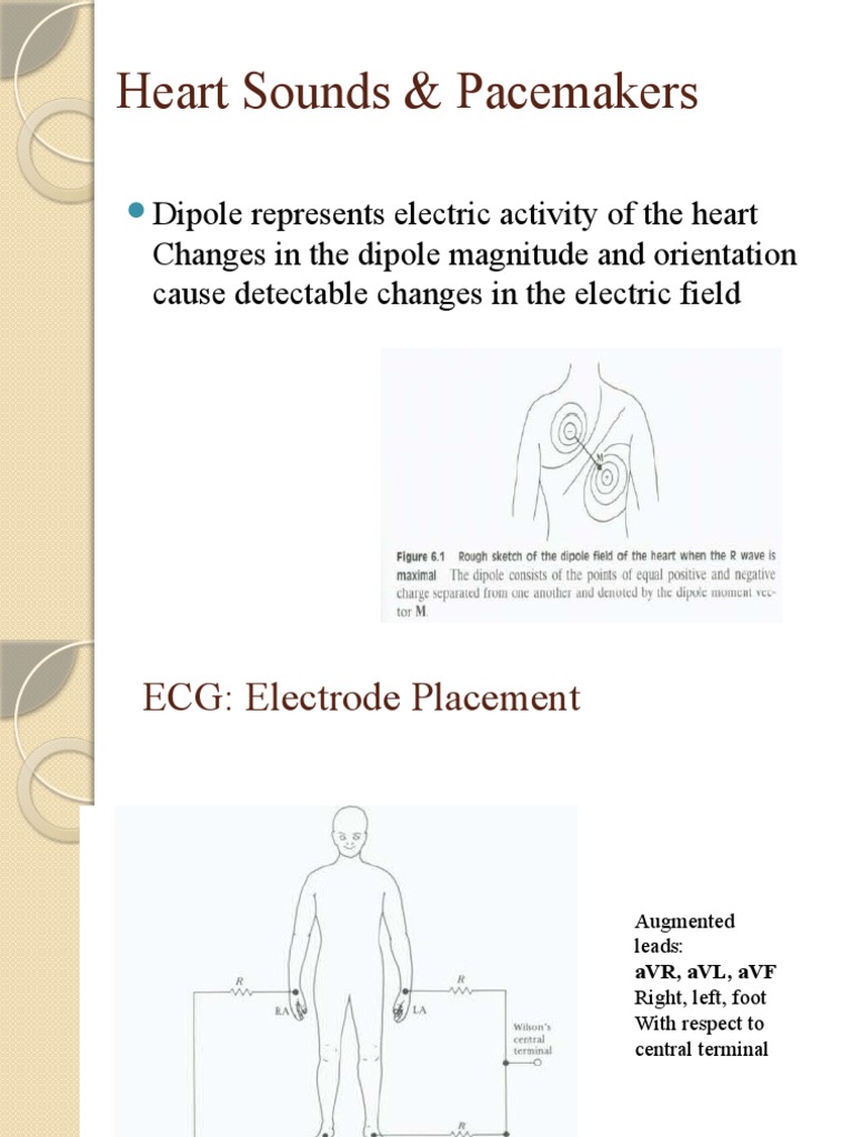 What Is The Pacemaker Sound? – Cardiac pacemaker – CNXJD