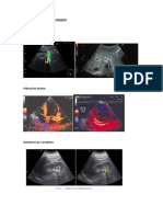 Artefactos en Imágenes Doppler