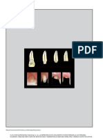 Classification For The Clinical Management of Endodontically Treated Single Anterior Teeth - Af.es