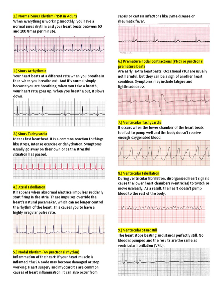 types-of-cardiac-arrhythmias-download-free-pdf-heart-physiology
