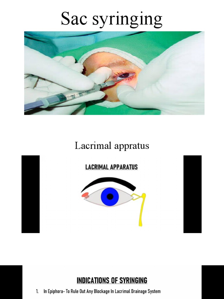 Sac Syringing-Ppt Lecture | PDF