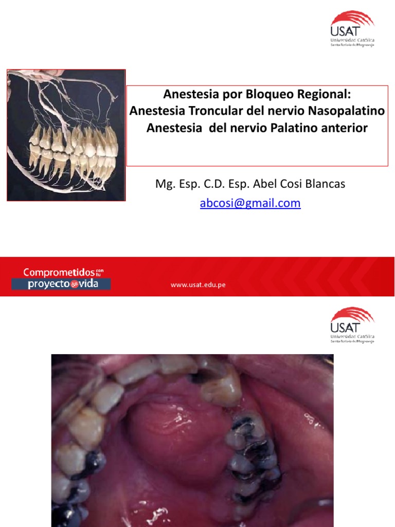Naso Palatino 2121 | PDF | Inyección (medicina) | Anestesia