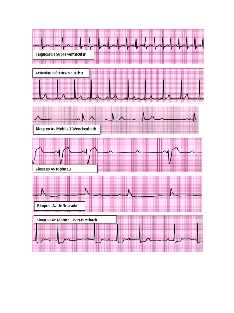 Manejo de Bradicardias y Taquicardias ACLS | PDF | Reanimación ...