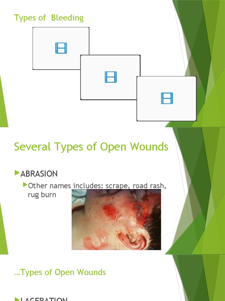 Types of Bleeding | PDF | Wound | Bleeding