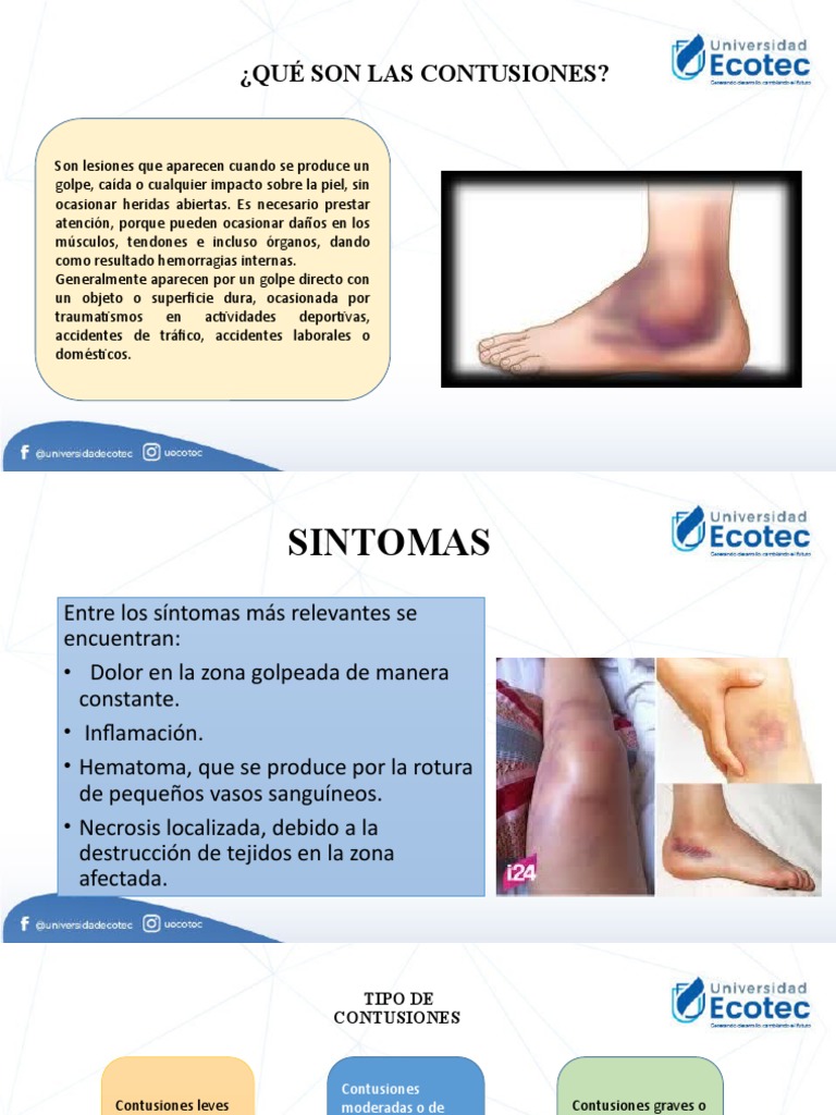 Contusion, Hilos de Sutura | PDF