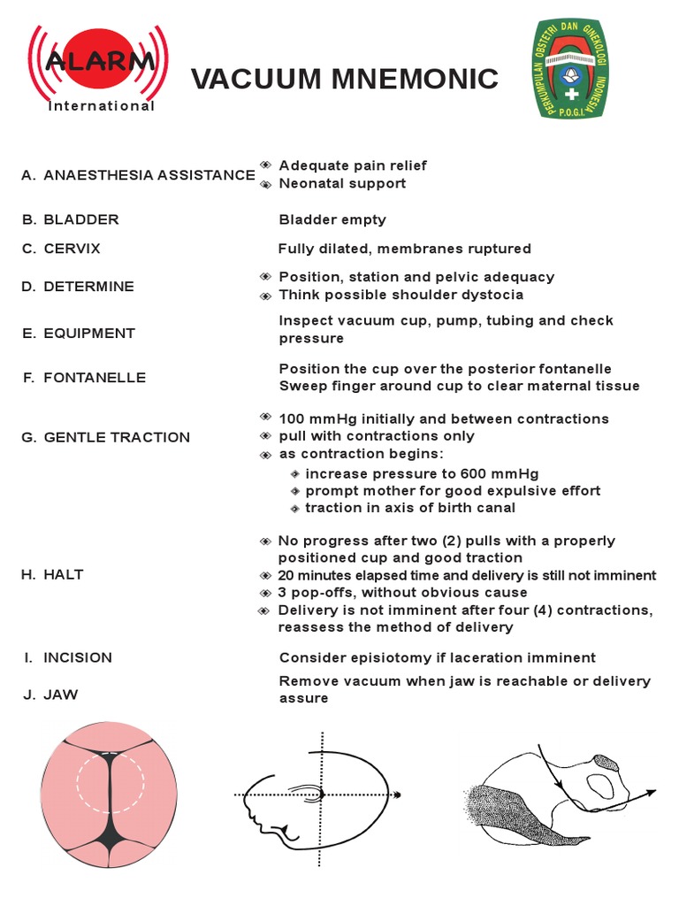 3 Vacuum Mnemonic Rev 2021 PDF