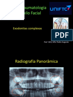 Cirurgia e Traumatologia Buco Maxilo Facial - Exodontias Complexas