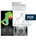 Acetabular Fracture