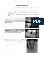 Enfermedad Periodontal