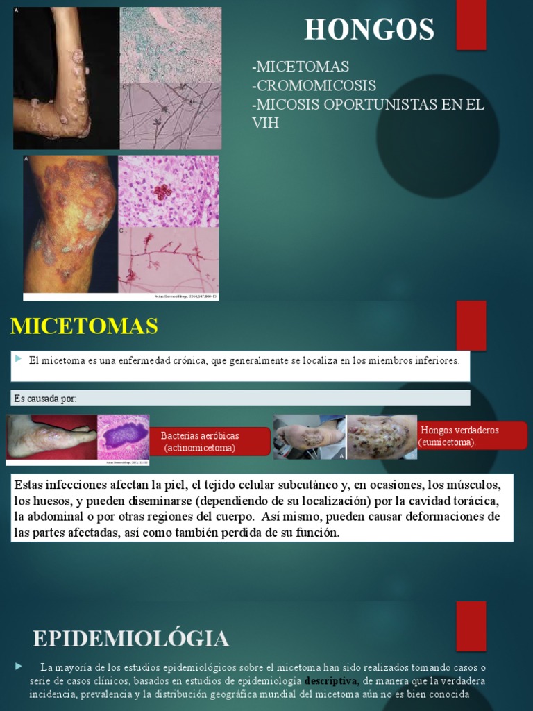 Hongos Oportunistas | PDF | VIH | Infección