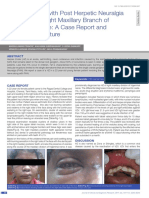 Herpes Zoster with Post Herpetic Neuralgia Involving the Right Maxillary Branch of Trigeminal Nerve