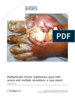 Multiarticular Chronic Tophaceous Gout With Severe and Multiple Ulcerations - A Case Report (Journal of Medical Case Reports, Vol. 5, Issue 1) (2011)