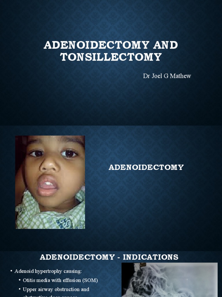 Adenoidectomy and Tonsillectomy Indications, Techniques, Complications and Postoperative Care
