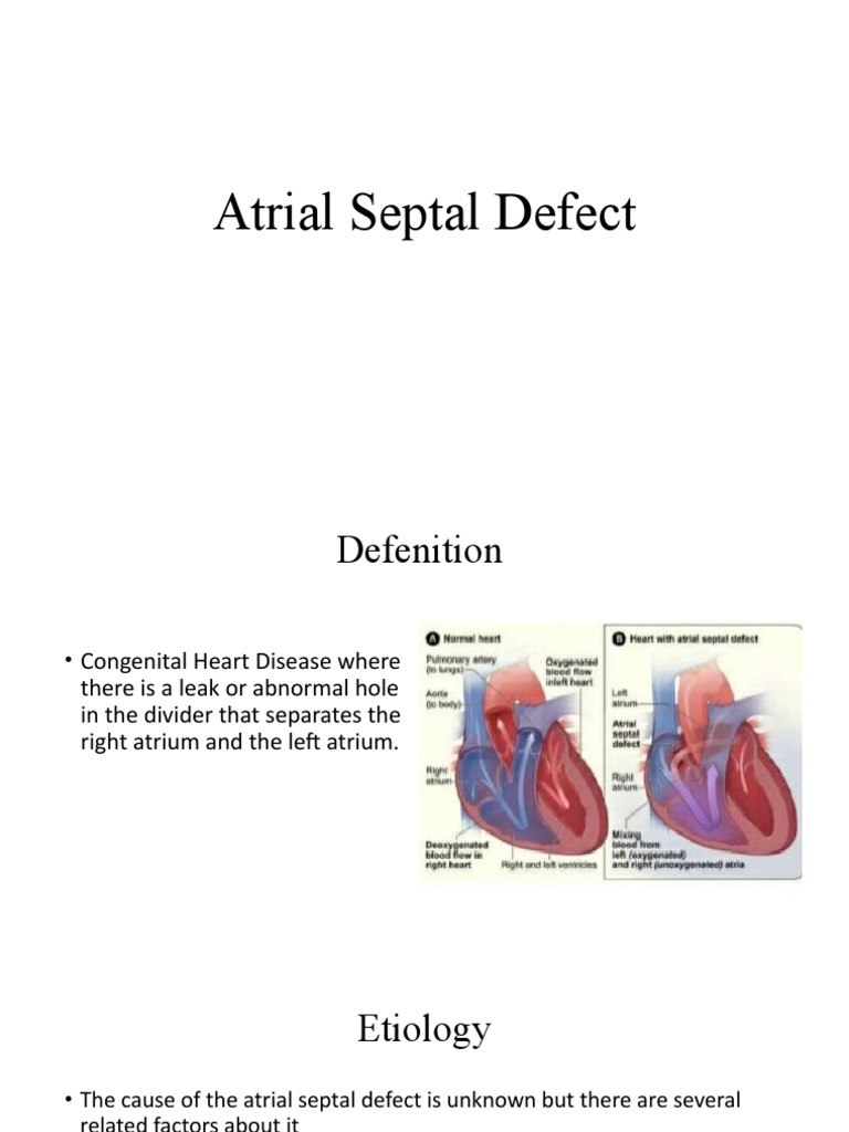 Atrial Septal Defect | PDF