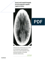 Asymptomatic Congenital CMV Cranial CT