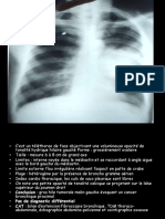 Clichés Thoraciques Avec Interprétation