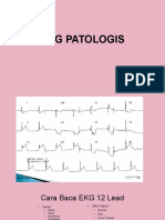 EKG PATHOLOGIS