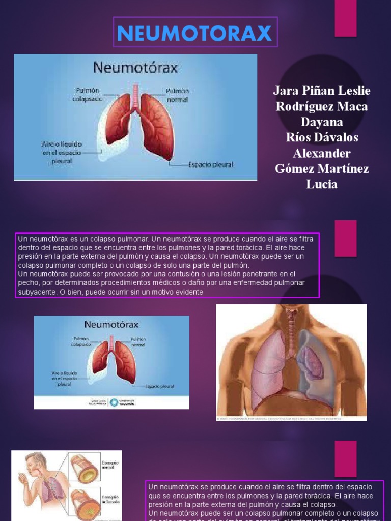 Neumotorax Final PDF Medicina CLINICA Enfermedades y trastornos