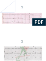 Ejemplos de EKG