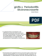 Gingivitis y Periodontitis Ulceronecrosante