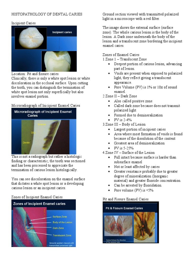 Histopathology of Dental Caries Zones | PDF | Dentin | Tooth Enamel