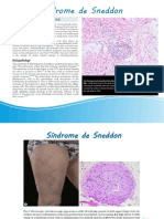 Síndrome de Sneddon y Melanoma. Sesión Derma 27.09.22 PDF