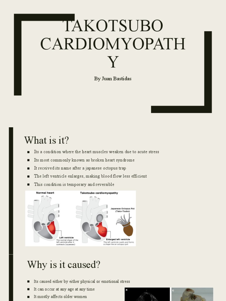 Understanding Takotsubo Cardiomyopathy | PDF